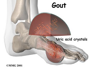can beans affect gout - the food and ailment joint can beans affect gout - the food and ailment joint