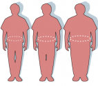 Childhood Obesity May Increase Risk For Heart Disease
