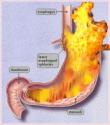 Home Remedies For Acid Reflux