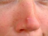 Herbal Remedies For Acne 
