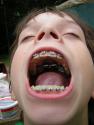 Halloween Treats For Kids With Braces