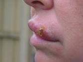 Home Remedies For Cold Sores