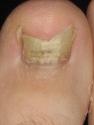 Home Remedies for Nail Fungus