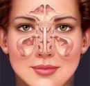 Herbal Remedies For Sinusitis 