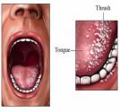 Home Remedies For Thrush