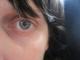 What To Do About Dark Circles Under Eyes