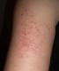 Herbal Remedies For Keratosis Pilaris 