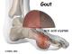 Can Beans Affect Gout? – The ‘gout-ed’ Not Full Of The Beans