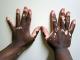 Herbal Remedies For Vitiligo