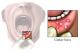 Home Remedies For Canker Sore