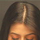 Natural Remedies For Dandruff During Pregnancy