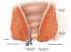 Home Remedies For Hemorrhoids