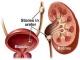 Top 5 Natural Remedies For Kidney Stones