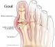 Best Foods To Control Gout