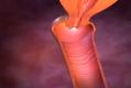 How To Cure Yeast Infection Permanently