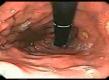 Overcoming Gastritis