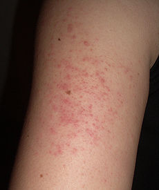 Keratosis Pilaris Treatment Reviews