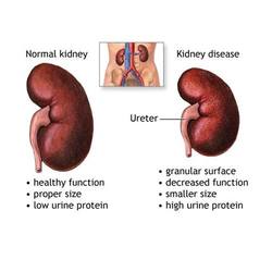 Kidney failure