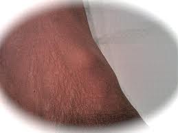 herbal remedies for cysts