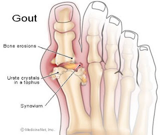 Gout big toe