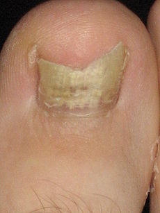 Nail fungus infection