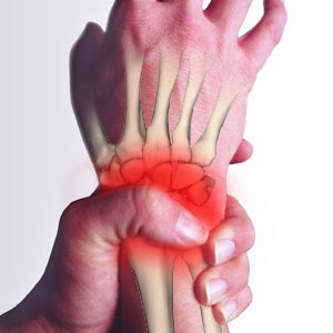 Rheumatoid arthritis 