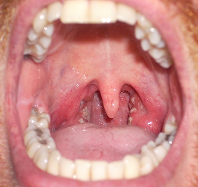 Streptococcal Sore Throat
