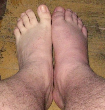 Disease Gout